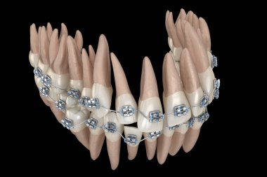 Anormal diş pozisyonu ve metal parantez tretament. Tıbbi olarak doğru diş 3d illüstrasyon