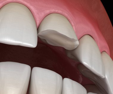 Kesici dişin merkezi kırılmış. İnsan dişleri ve protez kavramının tıbben doğru üç boyutlu çizimi