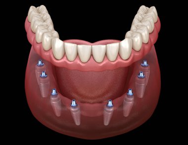 Mandibular protez Tüm 8 sistemi implantlar tarafından desteklenir. İnsan dişleri ve protezkavramının tıbbi olarak doğru 3d illüstrasyon