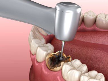 Caries çıkarma işlemi. Tıbbi olarak doğru diş 3D illüstrasyon.