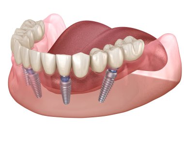 Alt çene protezi. Hepsi de implantlarla desteklenen 4 sistemde. İnsan dişleri ve protez kavramının tıbben doğru üç boyutlu çizimi