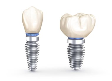 Diş implantları. İnsan dişlerinin 3 boyutlu illüstrasyon kavramı