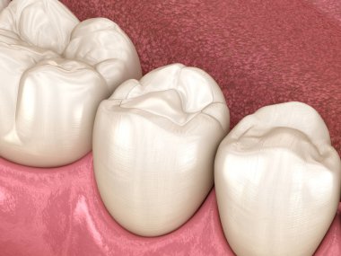 Dolgu ile premolar diş restorasyonu. Tıbbi olarak doğru diş 3d illüstrasyon.
