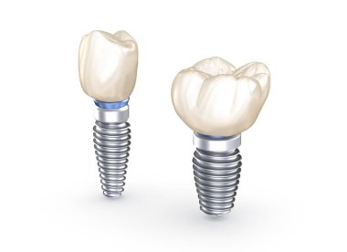 Diş implantları. İnsan dişlerinin 3 boyutlu illüstrasyon kavramı