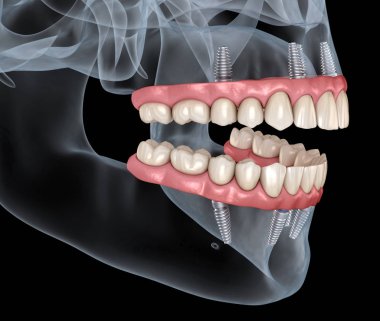 Alt çene ve üst çene protezi hepsi implantlar tarafından desteklenen 4 sistemde. İnsan dişleri ve protez kavramının tıbben doğru 3D çizimi