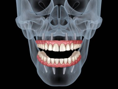 Alt çene ve üst çene protezi hepsi implantlar tarafından desteklenen 4 sistemde. İnsan dişleri ve protez kavramının tıbben doğru 3D çizimi