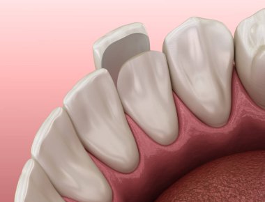 Alt çene vener kurulum prosedürü yanal kesici dişler üzerinde. Tıbbi olarak doğru diş 3D illüstrasyon