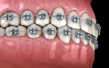 Metal parantez ile Sağlıklı Dişler. Tıbbi olarak doğru diş 3d illüstrasyon