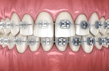 Metal ve Şeffaf diş telleri ile Dişler. Tıbbi olarak doğru diş 3d illüstrasyon