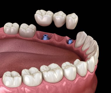 Diş köprüsü implantlarla destekleniyor. İnsan dişleri ve protez kavramının tıbben doğru üç boyutlu çizimi