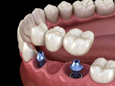 Diş köprüsü implantlarla destekleniyor. İnsan dişleri ve protez kavramının tıbben doğru üç boyutlu çizimi