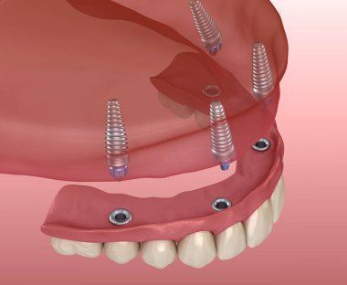 Çikletli Maxillary protezi. Hepsi de implantlarla desteklenen 4 sistemde. İnsan dişlerinin ve protezlerinin tıbbi açıdan doğru üç boyutlu çizimi