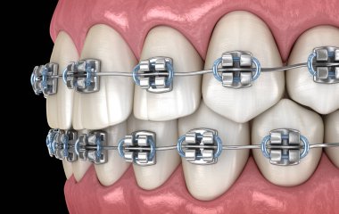 Metal parantez ile Sağlıklı Dişler. Tıbbi olarak doğru diş 3d illüstrasyon