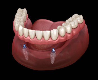 Alt çene çıkarılabilir protez. Hepsi top eklentili implantlar tarafından desteklenen 2 sistemde. Tıbbi olarak doğru olan 3 boyutlu diş illüstrasyonu