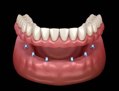 Çikletli çene protezi. Hepsi de implantlarla desteklenen 6 sistemde. İnsan dişleri ve protez kavramının tıbben doğru üç boyutlu çizimi