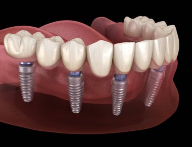 Çene protezi. Hepsi de implantlarla desteklenen 6 sistemde. İnsan dişleri ve protez kavramının tıbben doğru üç boyutlu çizimi