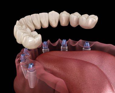 Çene protezi. Hepsi de implantlarla desteklenen 6 sistemde. İnsan dişleri ve protez kavramının tıbben doğru üç boyutlu çizimi