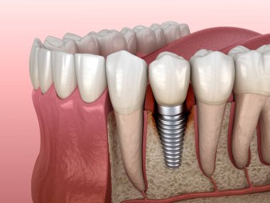 Görülebilir kemik hasarlı perisiplantit. Diş implantı kavramının tıbben doğru üç boyutlu çizimi