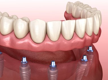 Çikletli çene protezi. Hepsi de implantlarla desteklenen 6 sistemde. İnsan dişleri ve protez kavramının tıbben doğru üç boyutlu çizimi