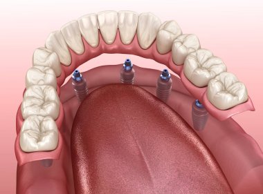 Çikletli çene protezi. Hepsi de implantlarla desteklenen 6 sistemde. İnsan dişleri ve protez kavramının tıbben doğru üç boyutlu çizimi