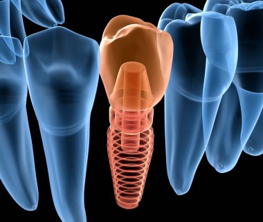İmplant ile premolar diş kurtarma, x-Ray görünümü. İnsan dişleri ve protezkavramının tıbbi olarak doğru 3d illüstrasyon