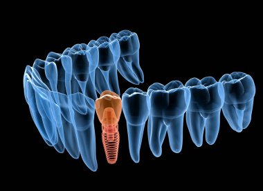İmplant ile premolar diş kurtarma, x-Ray görünümü. İnsan dişleri ve protezkavramının tıbbi olarak doğru 3d illüstrasyon