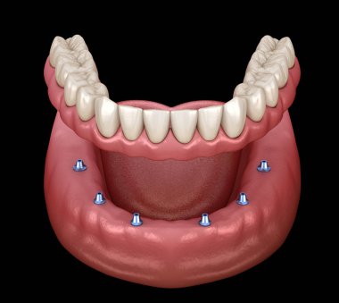 Çikletli çene protezi. Hepsi de implantlarla desteklenen 6 sistemde. İnsan dişleri ve protez kavramının tıbben doğru üç boyutlu çizimi
