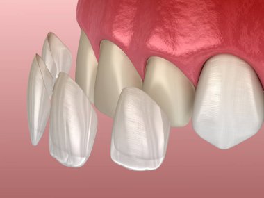 Merkezi kesici diş ve yan kesici diş üzerinde vener kurulum prosedürü. Tıbbi olarak doğru diş 3D illüstrasyon