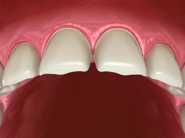 Merkezi kesici diş ve yanal kesici diş üzerinde Venedik kurulum prosedürü için diş hazırlığı. Tıbbi olarak doğru diş 3D illüstrasyon