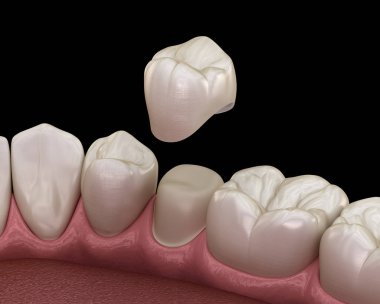 Diş taç yerleştirme için önceden paralanmış premolar diş. Tıbbi olarak doğru 3d illüstrasyon