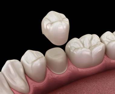 Diş taç yerleştirme için önceden paralanmış premolar diş. Tıbbi olarak doğru 3d illüstrasyon