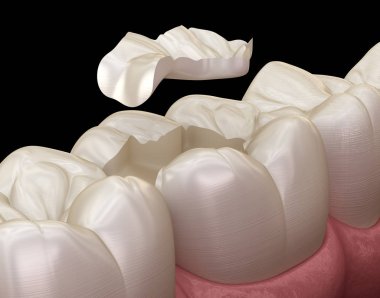 Inlay ceramic crown fixation over tooth. Medically accurate 3D illustration of human teeth treatment clipart