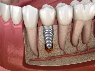 Görülebilir kemik hasarlı perisiplantit. Diş implantı kavramının tıbben doğru üç boyutlu çizimi