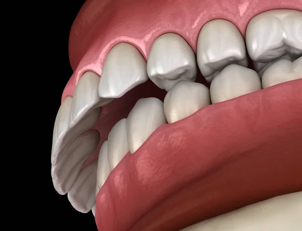 Overbite Okluzji Dentystycznej Zgryzu Zębów Medycznie Dokładna Ilustracja Zębów — Zdjęcie stockowe