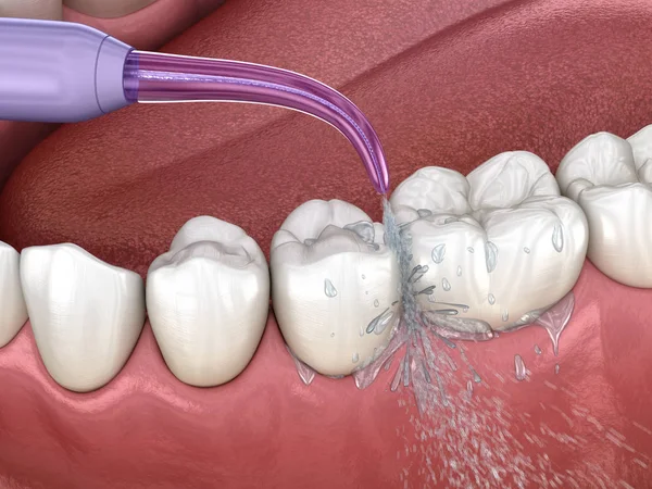 Tahriş Edici Dişleri Temizliği Ağız Hijyeni Tıbbi Olarak Doğru Illüstrasyon — Stok fotoğraf