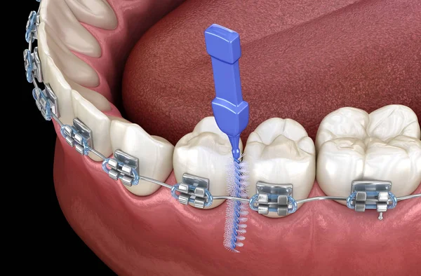 Unterkieferprothese Alle Auf System Durch Implantate Unterstützt Medizinisch Korrekte Darstellung — Stockfoto