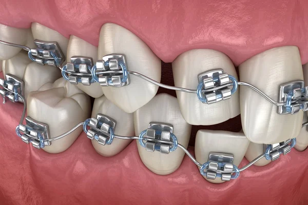 Аномальное Положение Зубов Металлические Брекеты Tretament Медицинская Точность Иллюстрации — стоковое фото