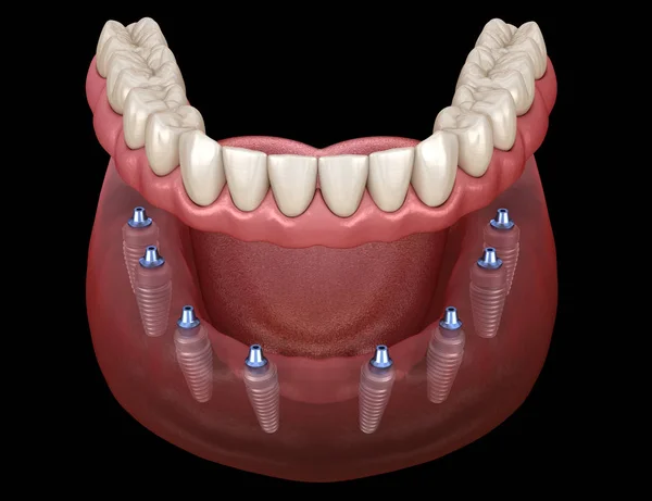 下颌假肢 所有8个系统支持植入物 人类牙齿和假牙概念的医学上精确的三维插图 — 图库照片