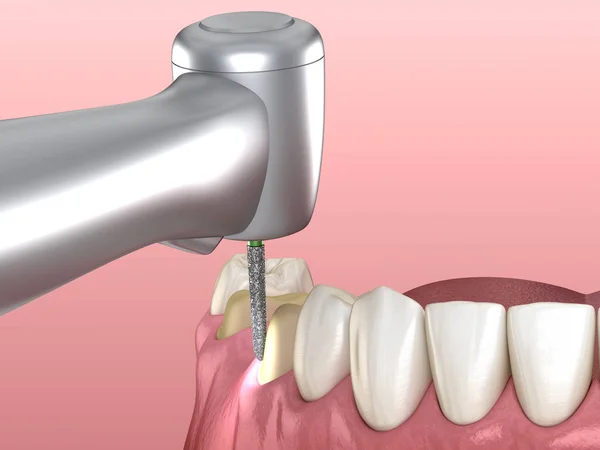 Premolar Förberedelseprocessen För Dental Crown Placering Medicinskt Korrekt Illustration — Stockfoto