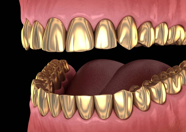 Golden teeth crowns over natural teeth. Medically accurate 3D illustration of human teeth treatment