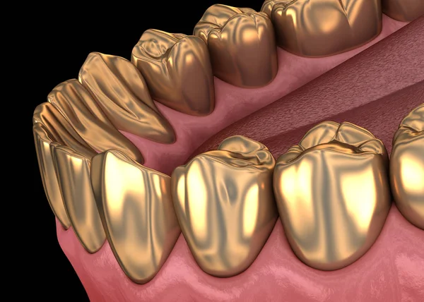 Gouden Tanden Kronen Natuurlijke Tanden Medisch Nauwkeurige Illustratie Van Menselijke — Stockfoto