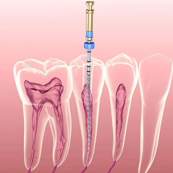 Endodontic root canal treatment process. Medically accurate tooth 3D illustration.