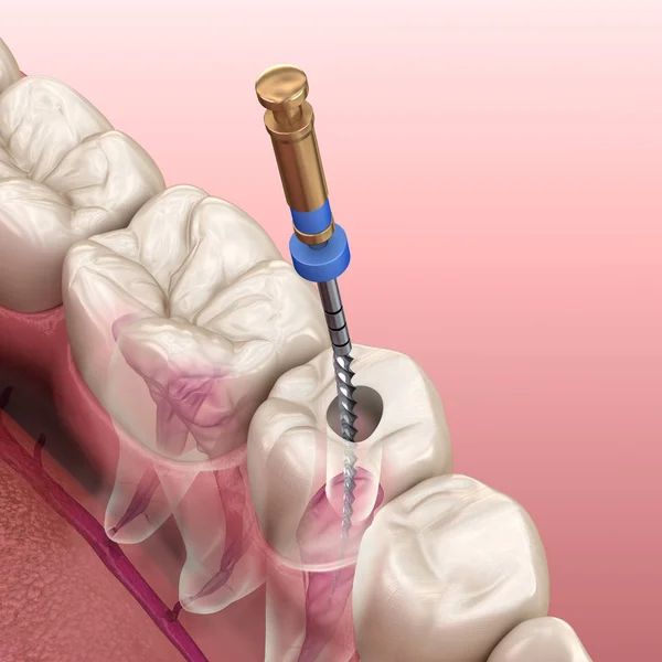 Endodontic root canal treatment process. Medically accurate tooth 3D illustration.