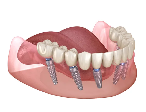 Mandibulaire Prothese Alles Systeem Ondersteund Door Implantaten Medisch Nauwkeurige Illustratie — Stockfoto