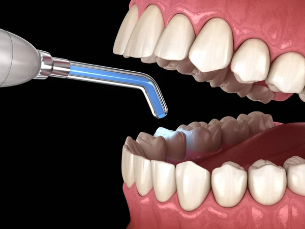 Zahnsanierung Mit Füllung Und Polymerisationslampe Medizinisch Korrekte Darstellung Der Zähne — Stockfoto