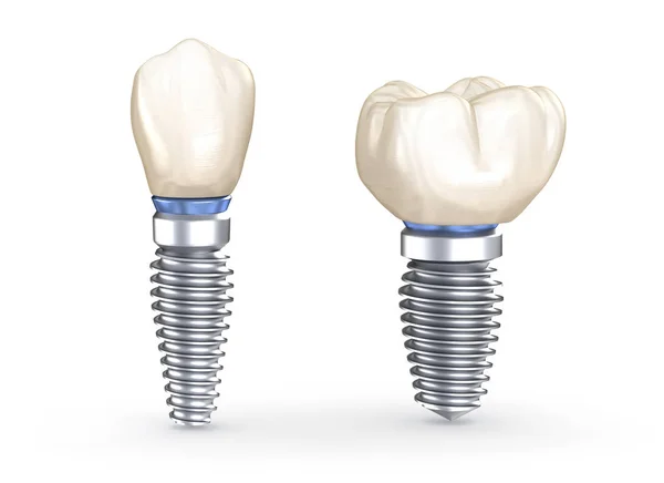 Diş Implantları Nsan Dişlerinin Boyutlu Illüstrasyon Kavramı — Stok fotoğraf