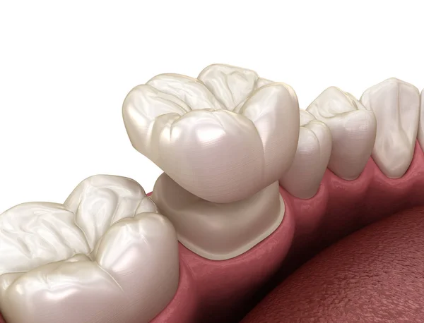 Підготовлений Молярний Зуб Розміщення Зубної Коронки Медично Точна Ілюстрація — стокове фото