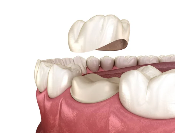 Förberedd Molar Tand För Tandkrona Placering Medicinskt Korrekt Illustration — Stockfoto