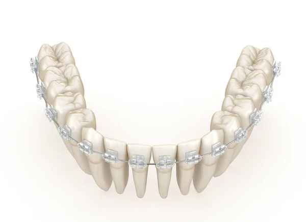 Teeth Clear Braces Illustration Concept — Stock Photo, Image