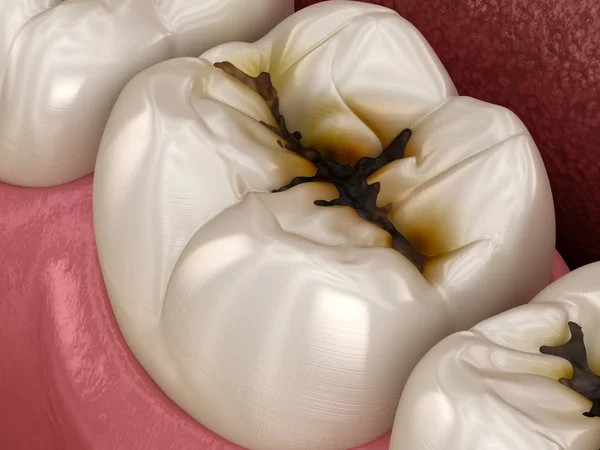 Molaire Tanden Beschadigd Door Cariës Medisch Nauwkeurige Tand Illustratie — Stockfoto